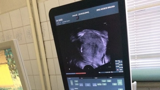W Klinice Urologii szpitala na Pomorzanach, stare wysłużone USG zastąpiono nowoczesnym aparatem, który wykrywa wczesne stadium raka prostaty. Dzięki dokładnemu badaniu można zdiagnozować chorobę u pacjentów, u których trudno ją wykryć. To pierwsze takie urządzenie w regionie.