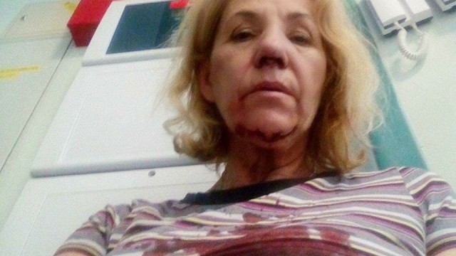 Została zaatakowana przez sąsiada na wybiegu dla psów - szukała pomocy prawnika i ją znalazła. Szczecinianka Krystyna Dwojewska w maju ubiegłego roku została uderzona przez swojego sąsiada w twarz. Powodem była kłótnia o agresywnego psa, którego sąsiad pani Krystyny puszczał luzem na wybieg. Mężczyzna połamał kobiecie nos, a w rozmowie z reporterem Radia Szczecin podkreślał, że szukał samoobrony.