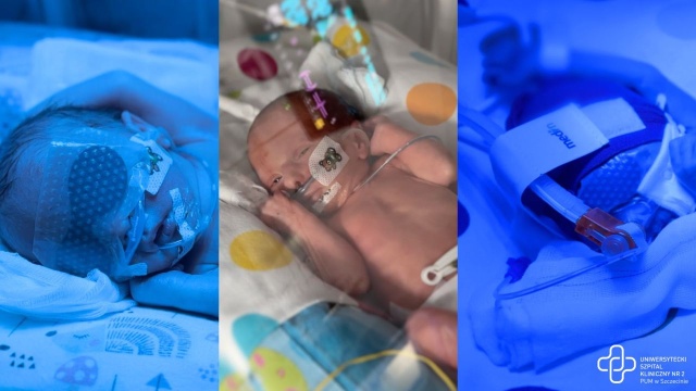 Taka ciąża zdarza się raz na osiem tysięcy przypadków.