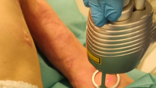 Ponad 20 małych pacjentów szpitala Zdroje w Szczecinie przejdzie do piątku kolejne testowe zabiegi z użyciem laserów CO2 i IPL.